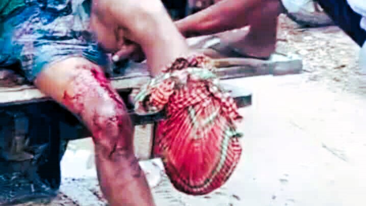 নাইক্ষ্যংছড়ি সীমান্তে মাইন বিস্ফোরণে এক যুবকের পা বিচ্ছিন্ন