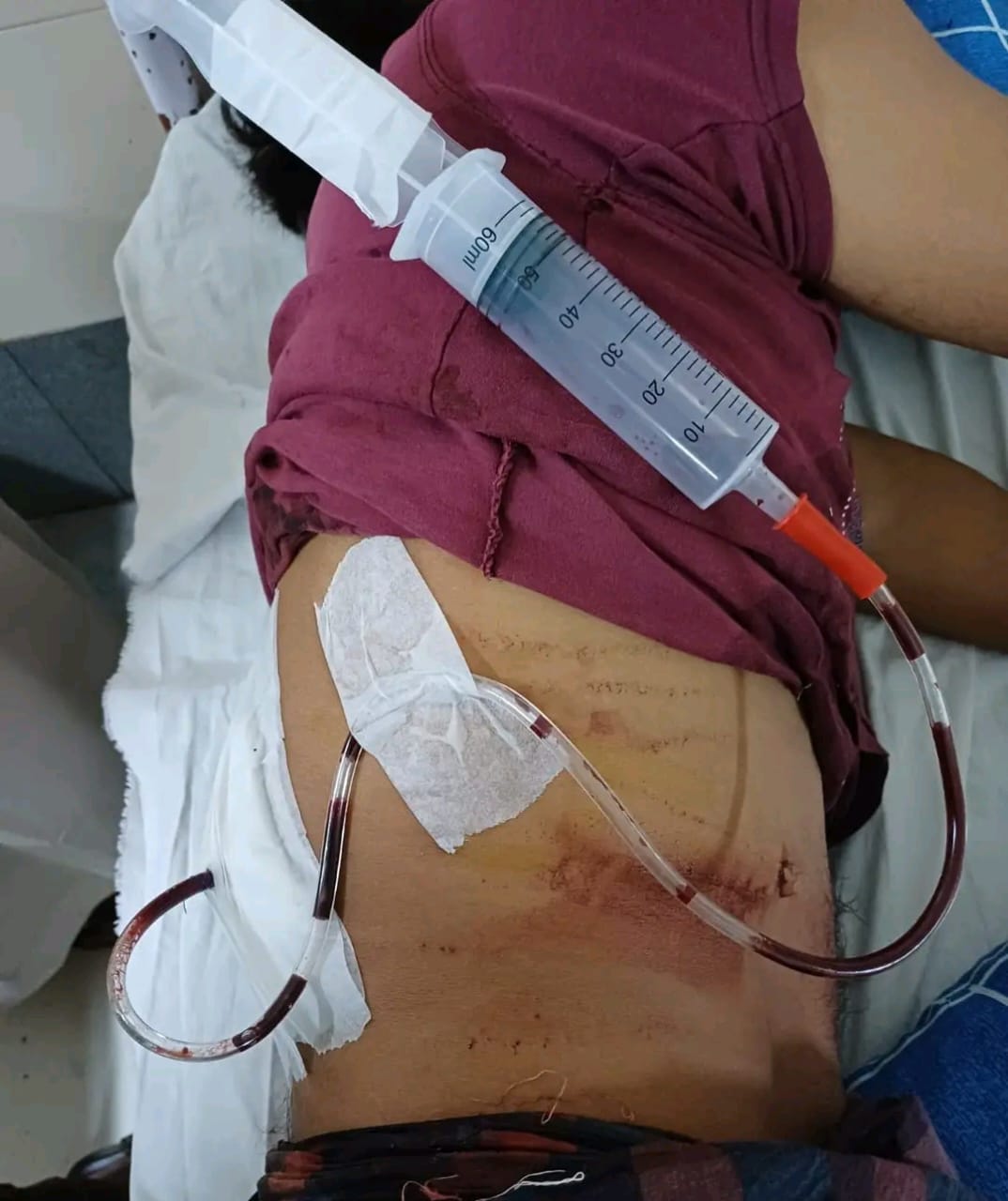 হাটহাজারীতে চুরির প্রতিবাদ করায় এক যুবককে ছুরিকাঘাত, থানায় অভিযোগ দায়ের